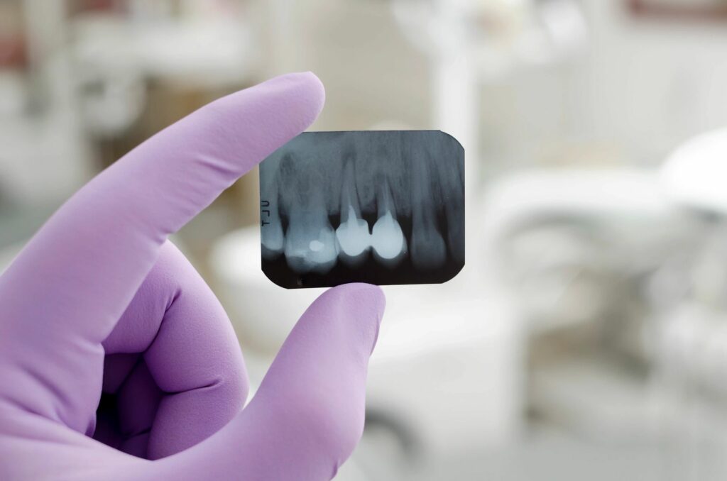 X-ray of teeth help identify tooth decay and more.